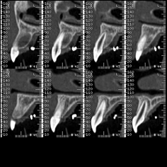 Scanner cone beam Coupe incisive